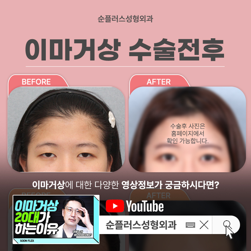 내시경 이마거상술 눈주변 주름개선에도 관련 이미지 6