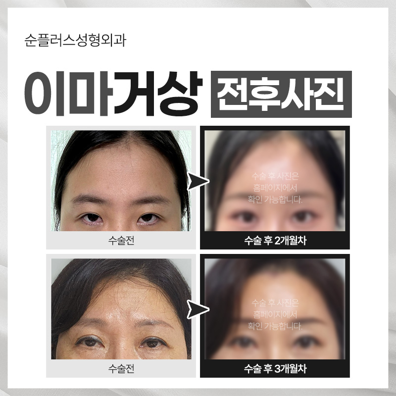 이마거상술효과 처진 이마와 눈매 개선을 동시에 리프팅 관련 이미지 4