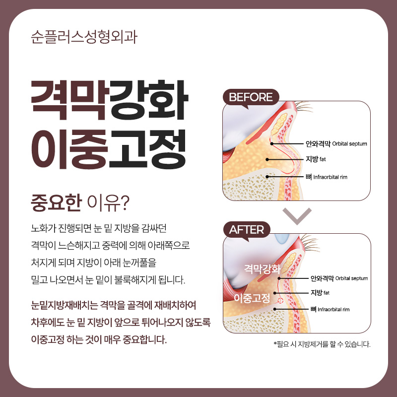 Why Under-Eye Fat Develops and Why Under-Eye Fat Repositioning May Be Needed image 4