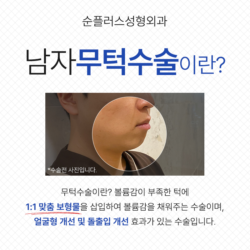 Balancing a Receding Chin to Enhance Attractiveness image 2