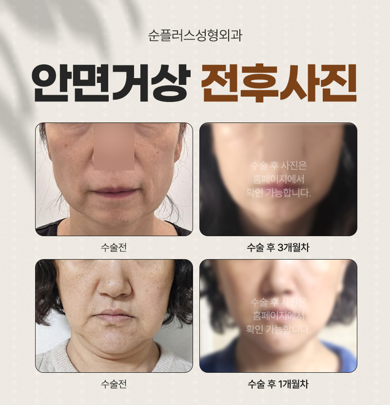 강남 안면거상성형외과 동안으로 가는 길 관련 이미지 5