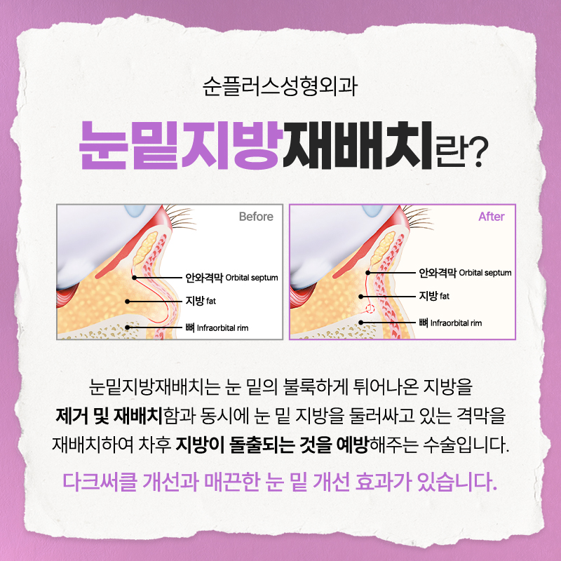 눈밑지방재배치잘하는병원, 결과 차이를 만드는 병원 선택 기준 관련 이미지 2