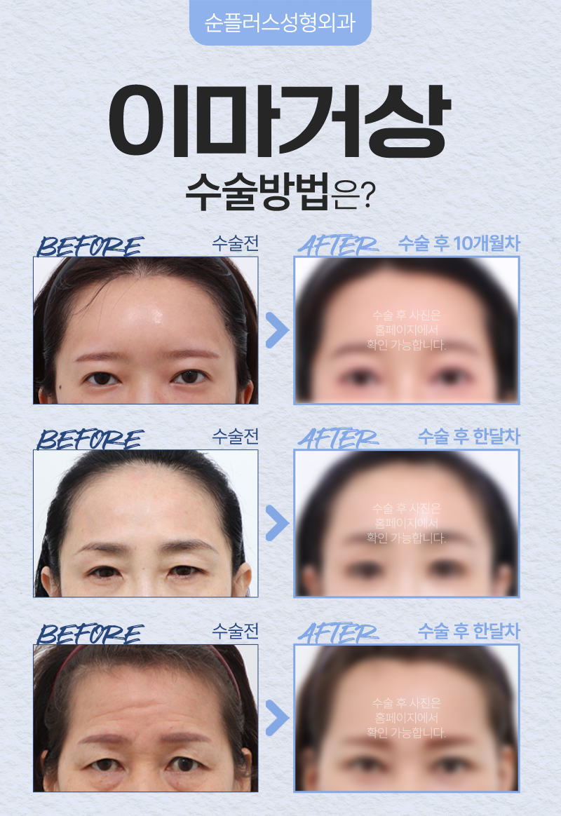 처진 이마와 눈썹, 이마리프팅(이마거상)으로 어떻게 달라질까 관련 이미지 4