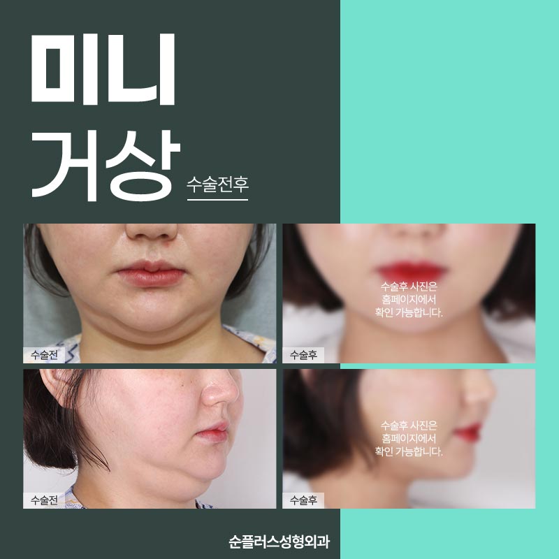 스마스층까지 당겨주는 미니거상술 관련 이미지 4