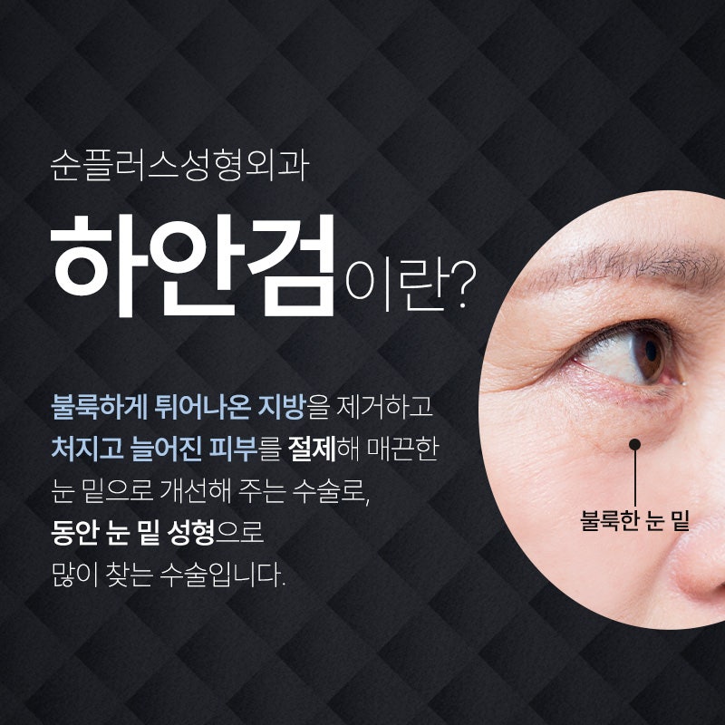Under-Eye Fat Surgery: What to Do When Fat Builds Up with Aging and Under-Eye Sagging Appears image 2