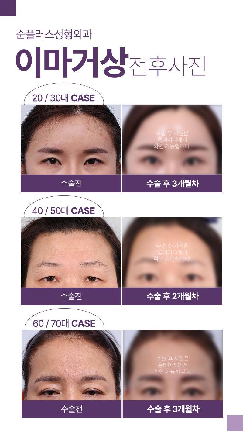 내시경 이마거상 피부 처짐에 따른 맞춤 솔루션 관련 이미지 5