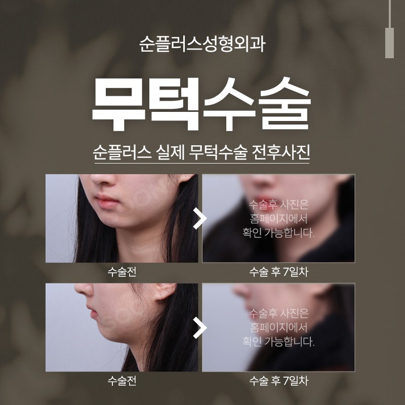 짧고 밋밋한 무턱교정, 보형물 무턱수술 통해 자연스러운 턱라인 관련 이미지 5