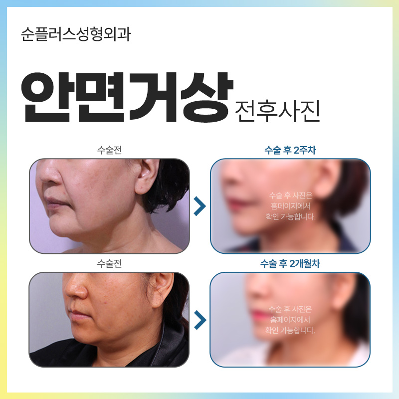 안면거상술잘하는병원 탄력효과를 오래 유지하려면 관련 이미지 5