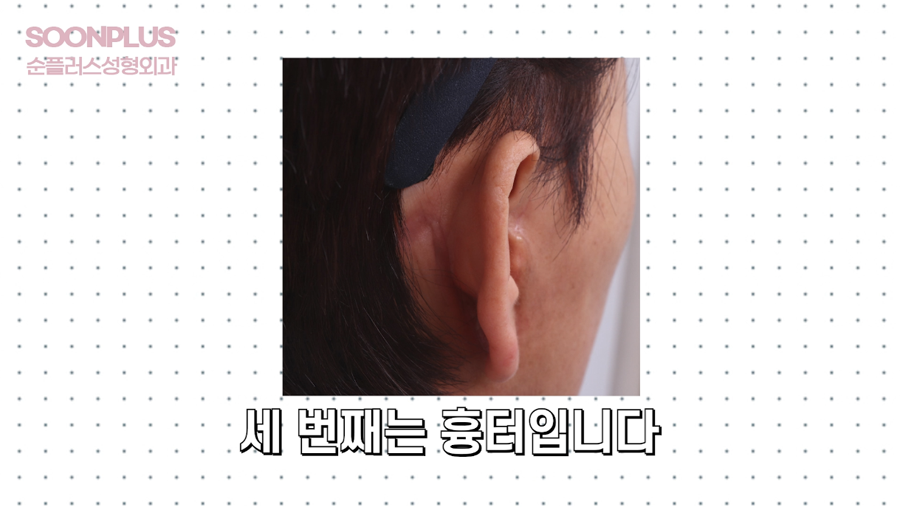 안면거상부작용 왜 나타날까? [칼귀/구렛나루 소실/피부괴사] 관련 이미지 4