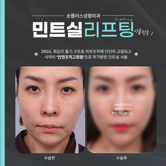 Which Thread Lifting Clinic Should You Choose? image 4