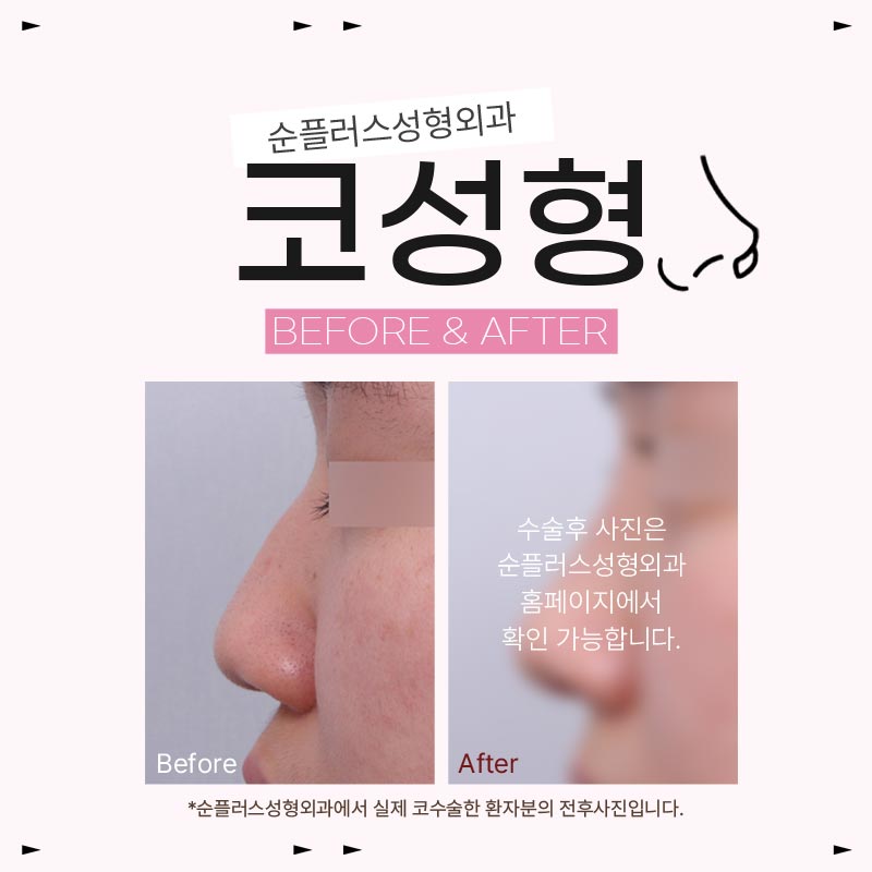 Well-Known Rhinoplasty Clinic for Preserving Balance image 5