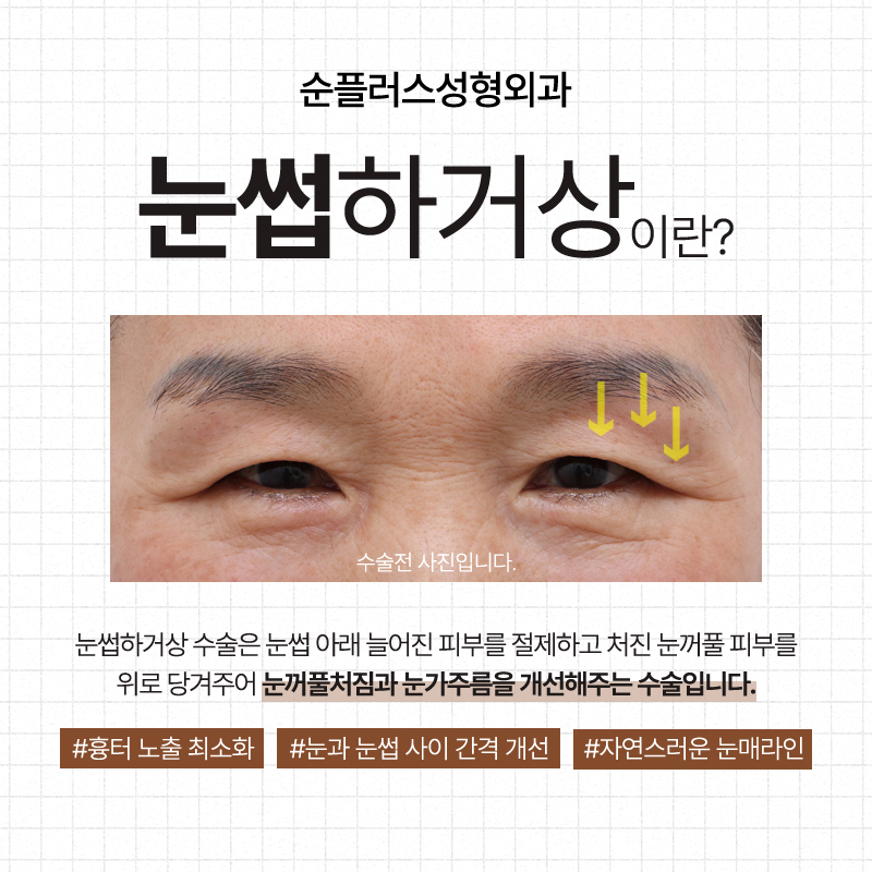 Making Parents’ Drooping Eyelids Look Clearer with the Effect of a Sub-Brow Lift image 2