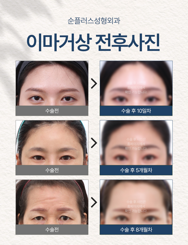 내시경이마거상 붓기, 유지기간 등 회복에 대해 관련 이미지 5