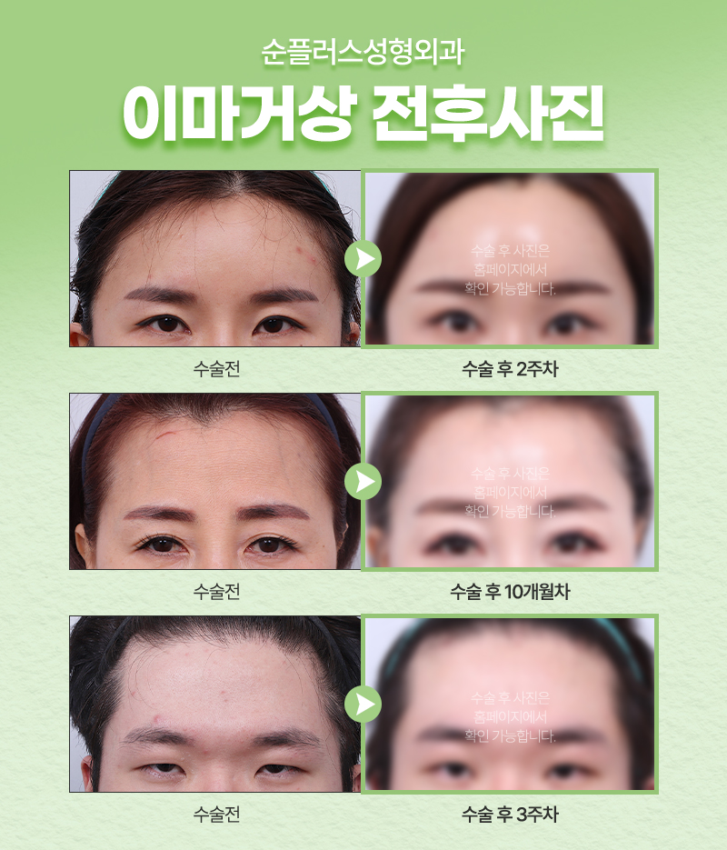 강남/신사 이마거상잘하는곳 선택이 많은 이유는 관련 이미지 4