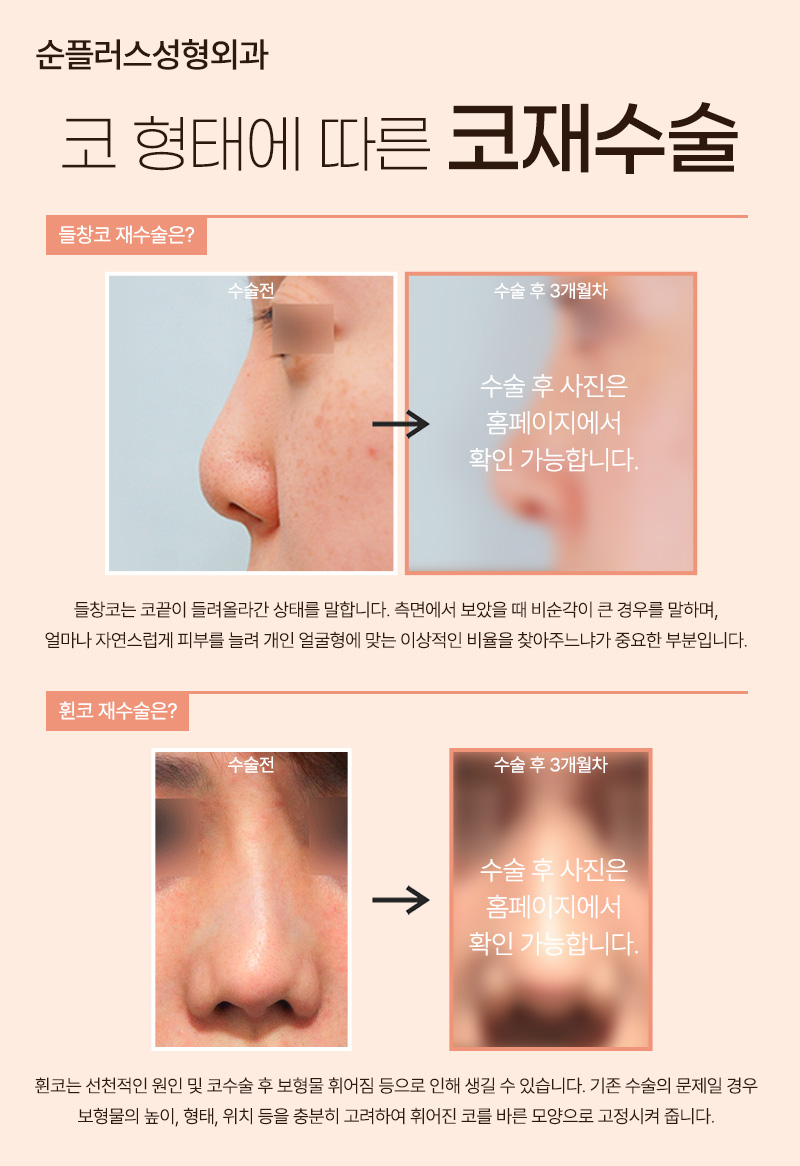 Where to Get Nose Revision Surgery Done Well: Find the Cause and Correct It Properly image 6