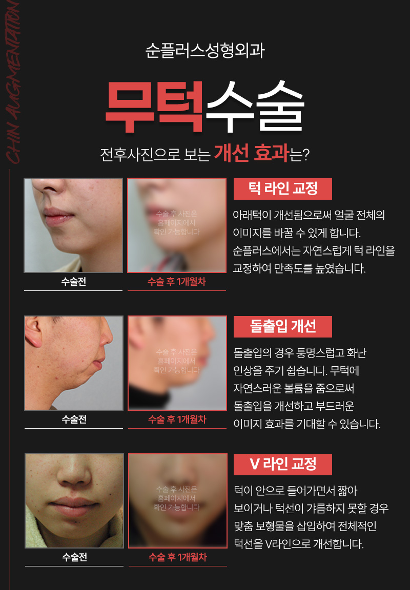 짧은턱 작은턱 일명 무턱콤플렉스 개선위해 관련 이미지 4