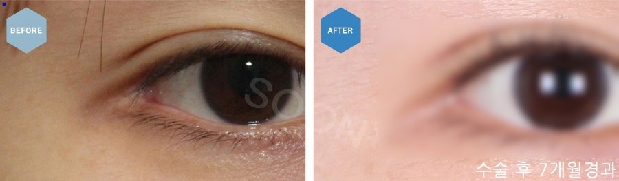 The approach to revision outer corner surgery varies depending on the cause image 6