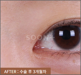몽고주름으로 답답한 눈매, 부자연스러운 쌍꺼풀라인 개선 위한다면 올바른 앞트임 방법으로 관련 이미지 2