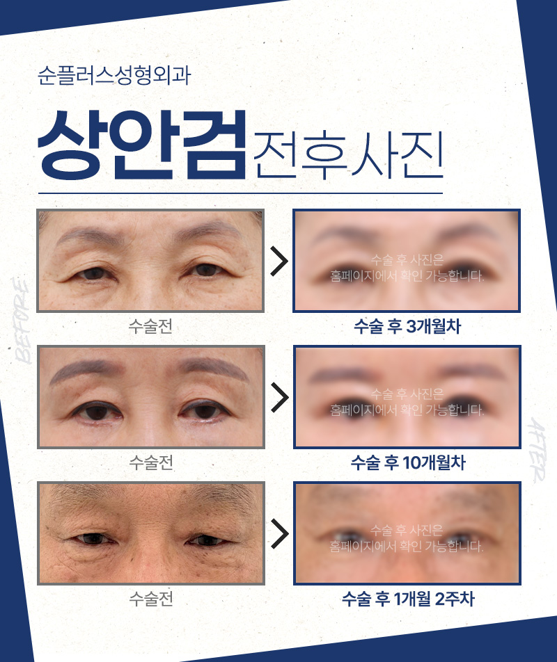 노화로 처진 눈꺼풀, 중년눈성형에 적합한 수술방법을 적용해야 [상안검수술] 관련 이미지 6