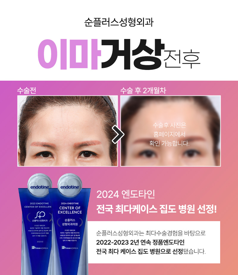 Is forehead lift only recommended for people in their 40s and 50s, and not recommended for people in their 20s and 30s? image 6