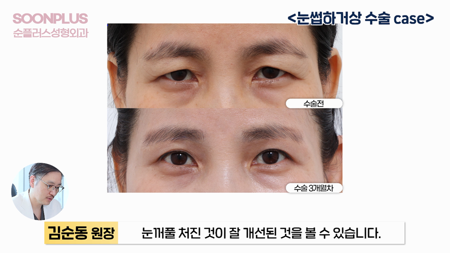 What Surgery Is Performed to Improve Drooping Eyelids and Sagging Eyes, Even by Celebrities? image 5