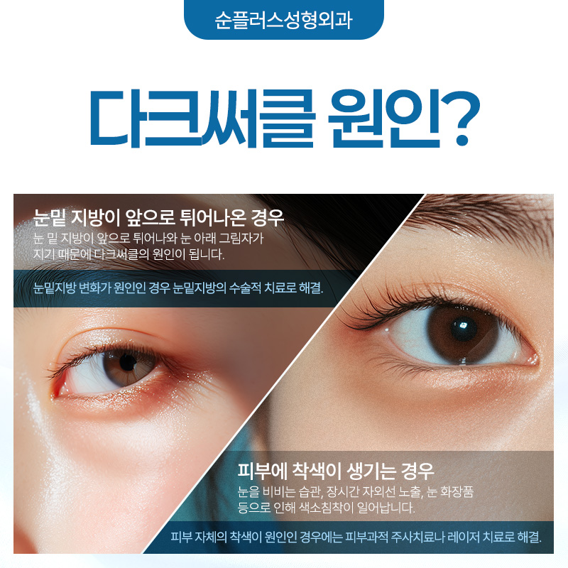 눈밑지방재배치수술 회복은 빠르게 재발은 없도록 관련 이미지 3