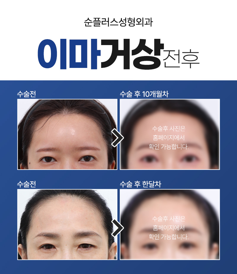 Differences in the Effect of Endoscopic Forehead Lift by Age image 5