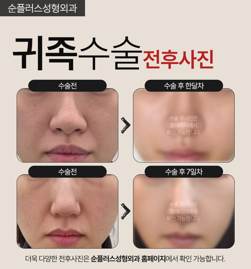 귀족성형-코옆꺼짐 원인으로 팔자주름 깊어보인다면 관련 이미지 5