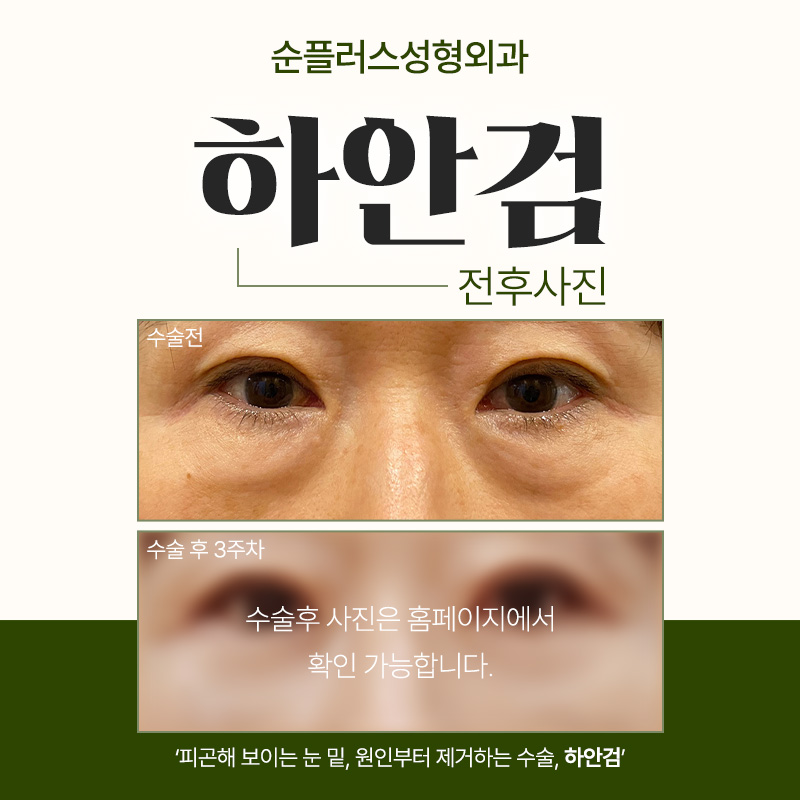 하안검수술잘하는곳 늘어짐은 사라지고 인상 밝게 관련 이미지 5