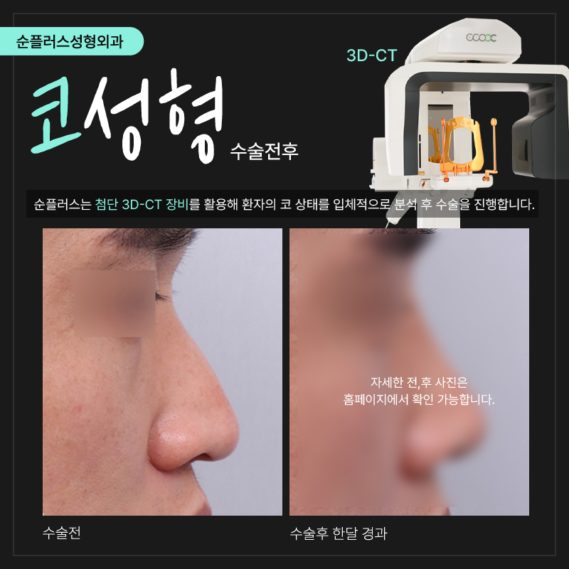코성형외과 비율을 조화롭게 관련 이미지 6