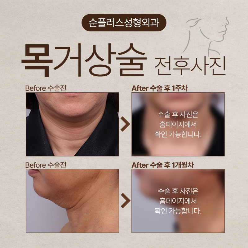 Neck Lift Surgery to Improve Sagging Neck and Neck Wrinkles image 5