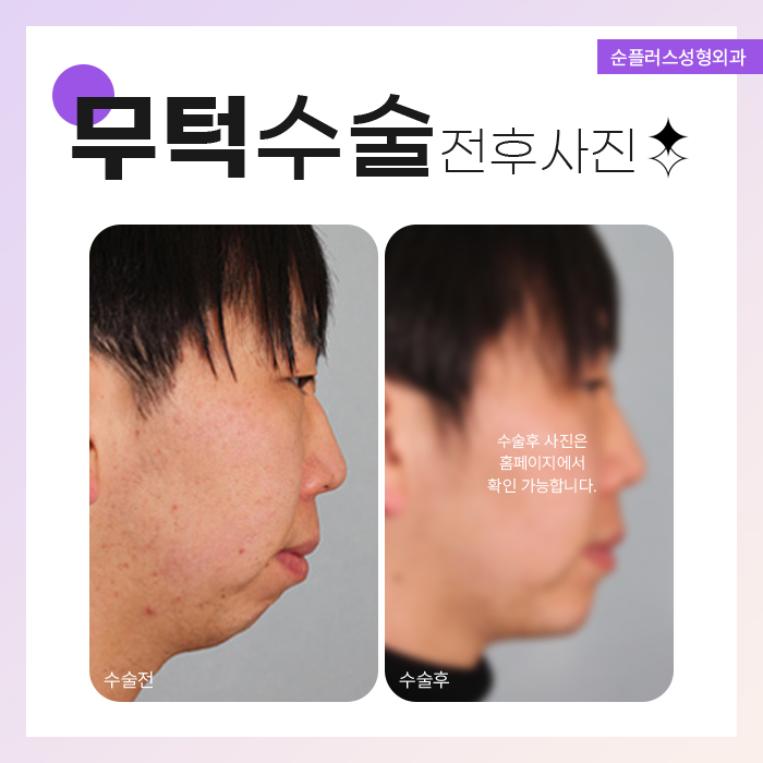 무턱수술잘하는곳 환자별 디자인도 다르게 관련 이미지 5