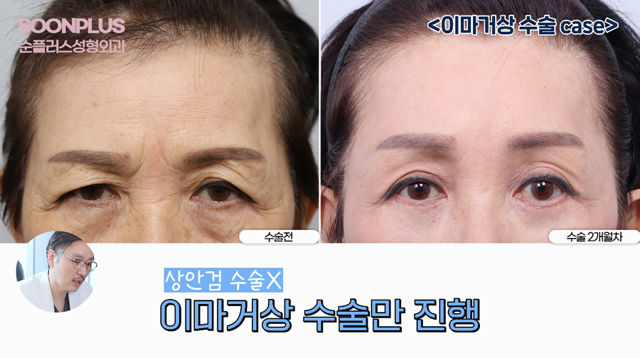 What Surgery Is Performed to Improve Drooping Eyelids and Sagging Eyes, Even by Celebrities? image 8
