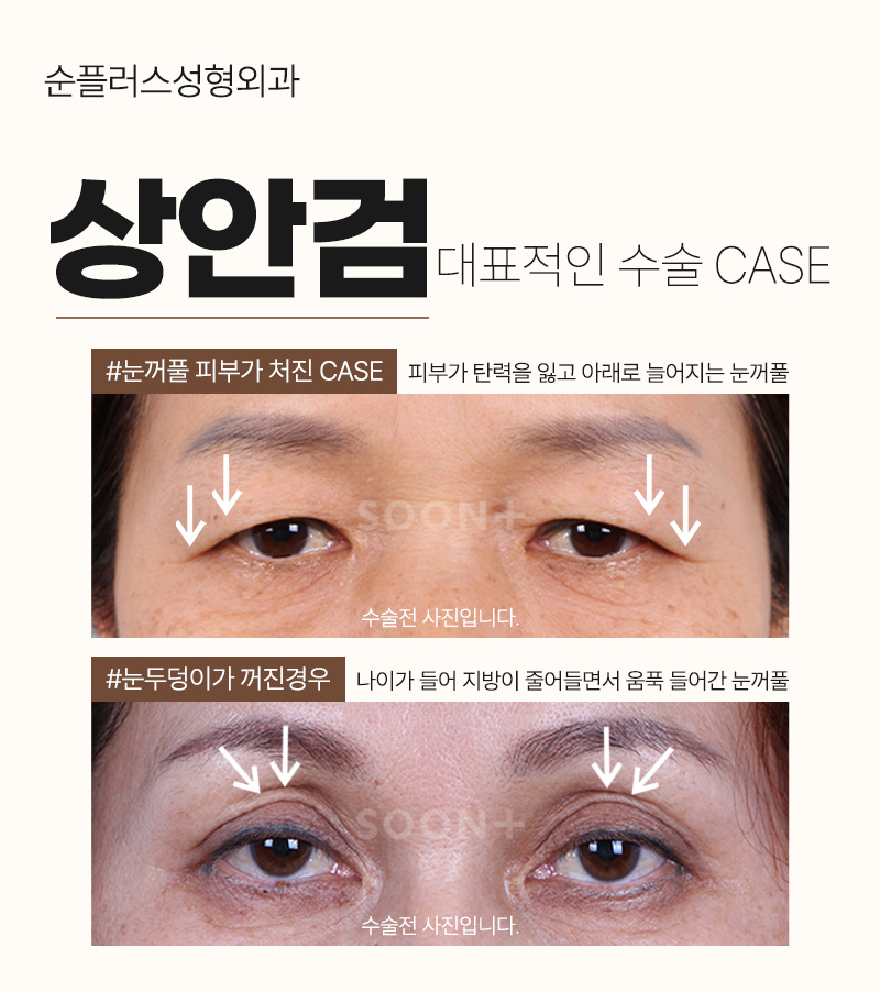 노화로 처진눈꺼풀 자연스러운 쌍꺼풀라인 위해 관련 이미지 3