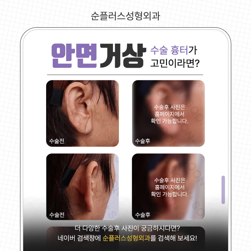 The Best Place for Facelift Surgery When Skin Elasticity Changes image 6
