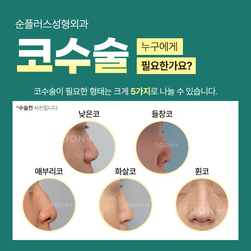 Rhinoplasty Surgery: The Right Process Matters image 3