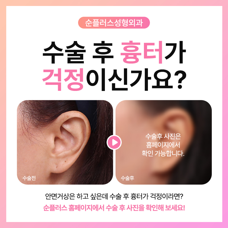 Facelift in Your 30s and 40s, Even If You're Not Middle-Aged image 5