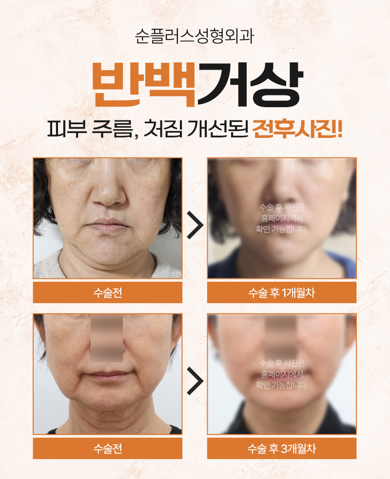 나이들어 보이는 얼굴 반백거상(안면거상)으로 어려질 수 있을까 관련 이미지 7