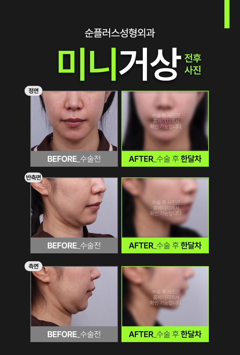 미니거상 섬세한 스마스층 조절로 유지기간 늘리고 흉터 최소화까지 관련 이미지 5