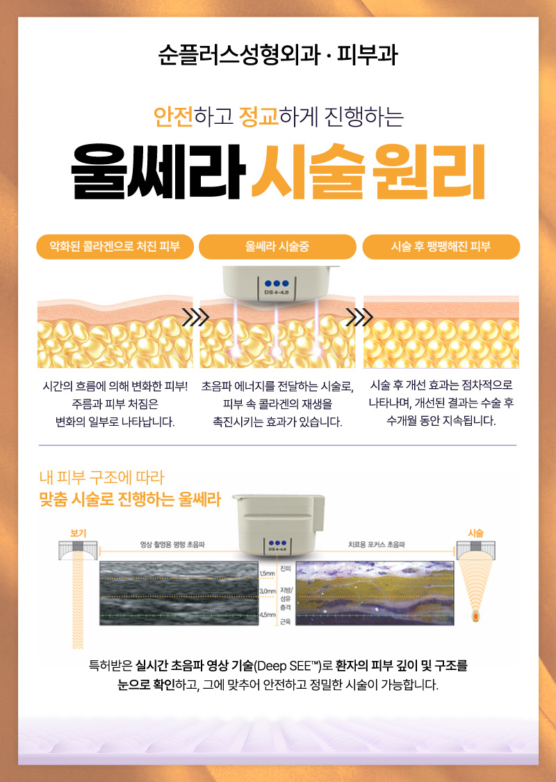 울쎄라, 써마지 따로 또 같이? [순플러스 최용화 원장이 알려주는 울써마지] 관련 이미지 2