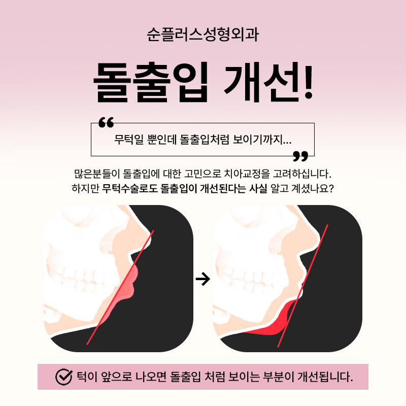 무턱수술ㅣ어떤 보형물이 적합할지 고민될때 관련 이미지 4
