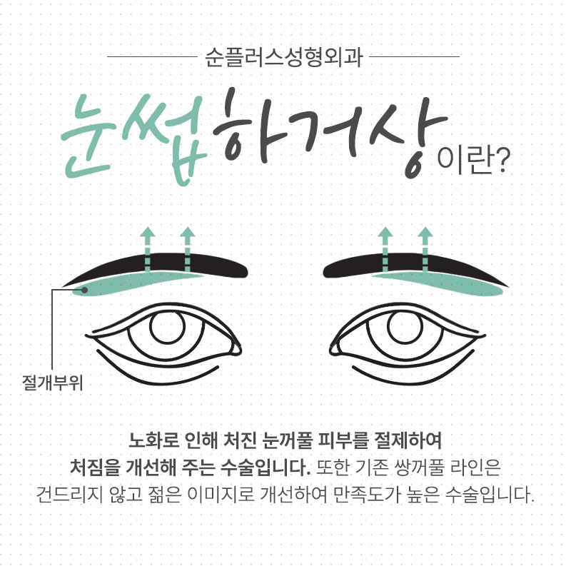 [눈썹거상수술] 눈과 눈썹 거리가 먼 경우, 눈꺼풀이 처졌을때 관련 이미지 2