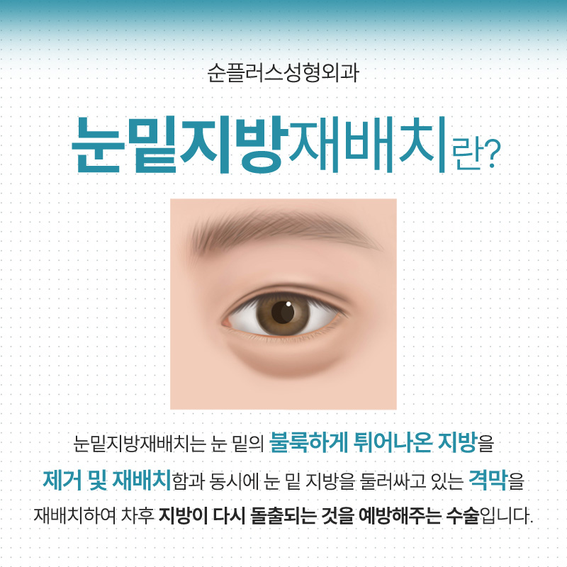 눈밑지방재배치 수술후 차후에도 지방이 돌출되지 않도록 이중고 관련 이미지 2