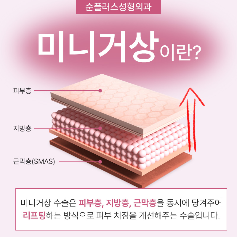 미니안면거상술 심하게 늘어지기 전에 관련 이미지 3