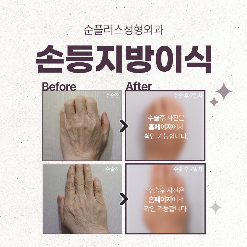 울퉁불퉁했던 손등 손지방이식 후 매끄럽게 관련 이미지 6