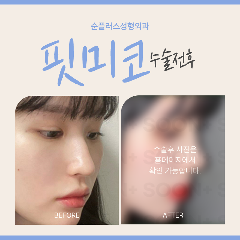 개별 맞춤보형물로 완성도를 높여주는 핏미코 관련 이미지 5