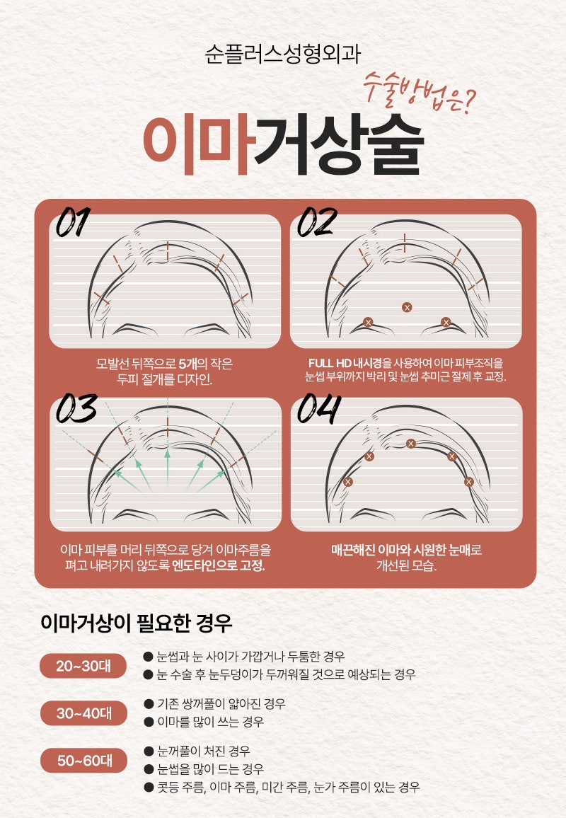 For Improving Endotine Brow Lift Fixation and Durability image 6