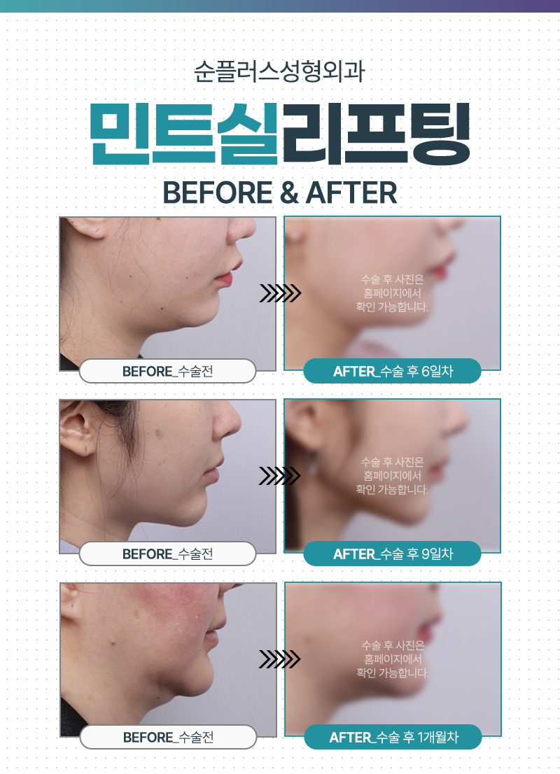 이중턱실리프팅 PDO실로 콜라겐 재생까지 관련 이미지 6