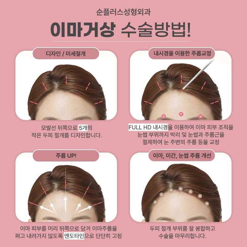 Forehead Wrinkle Removal Surgery, Including Between the Eyebrows and the Bridge of the Nose image 6