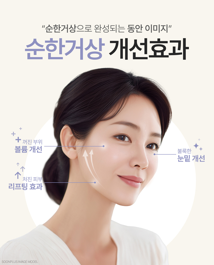 A Gentle and Natural Composite Lifting with Mini Facelift + Lower Blepharoplasty + Fat Grafting [Sunplus Gentle Lifting] image 5